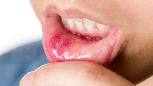 Osiem najczęstszych infekcji jamy ustnej
