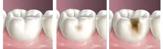 cavities